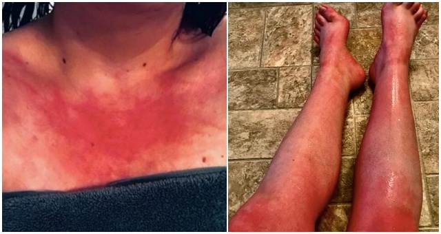 Žena má nezvyčajnú alergiu, je totiž alergická na vodu, čo ju mimoriadne obmedzuje