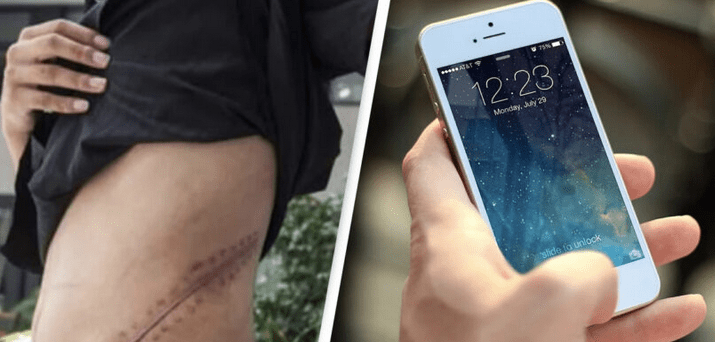Tínedžer, ktorý predal obličku, aby si kúpil iPhone, má teraz vážne zdravotné problémy