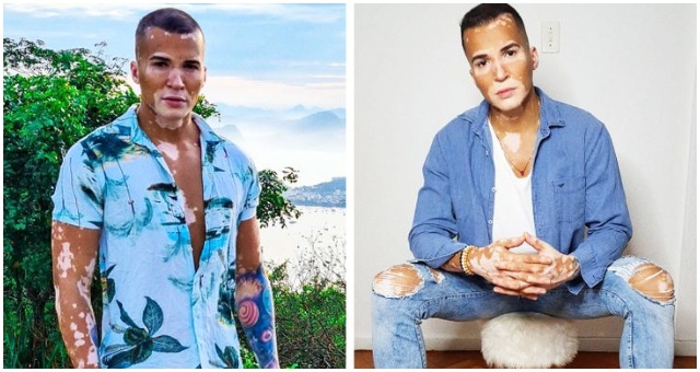 Kedysi svoje vitiligo prekrýval make-upom, dnes je už však všetkému inak
