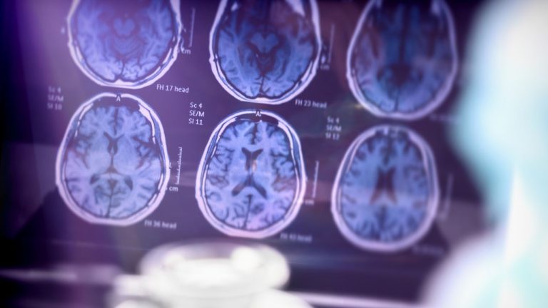 Nový AI nástroj môže byť prelomom v boji proti Alzheimerovej chorobe