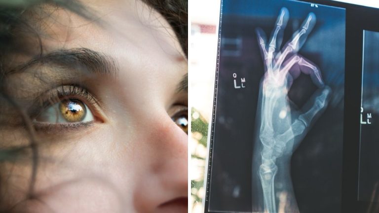 Vzácne anomálie ľudí, spôsobené genetickou mutáciou. Prečítajte si o nich viac!