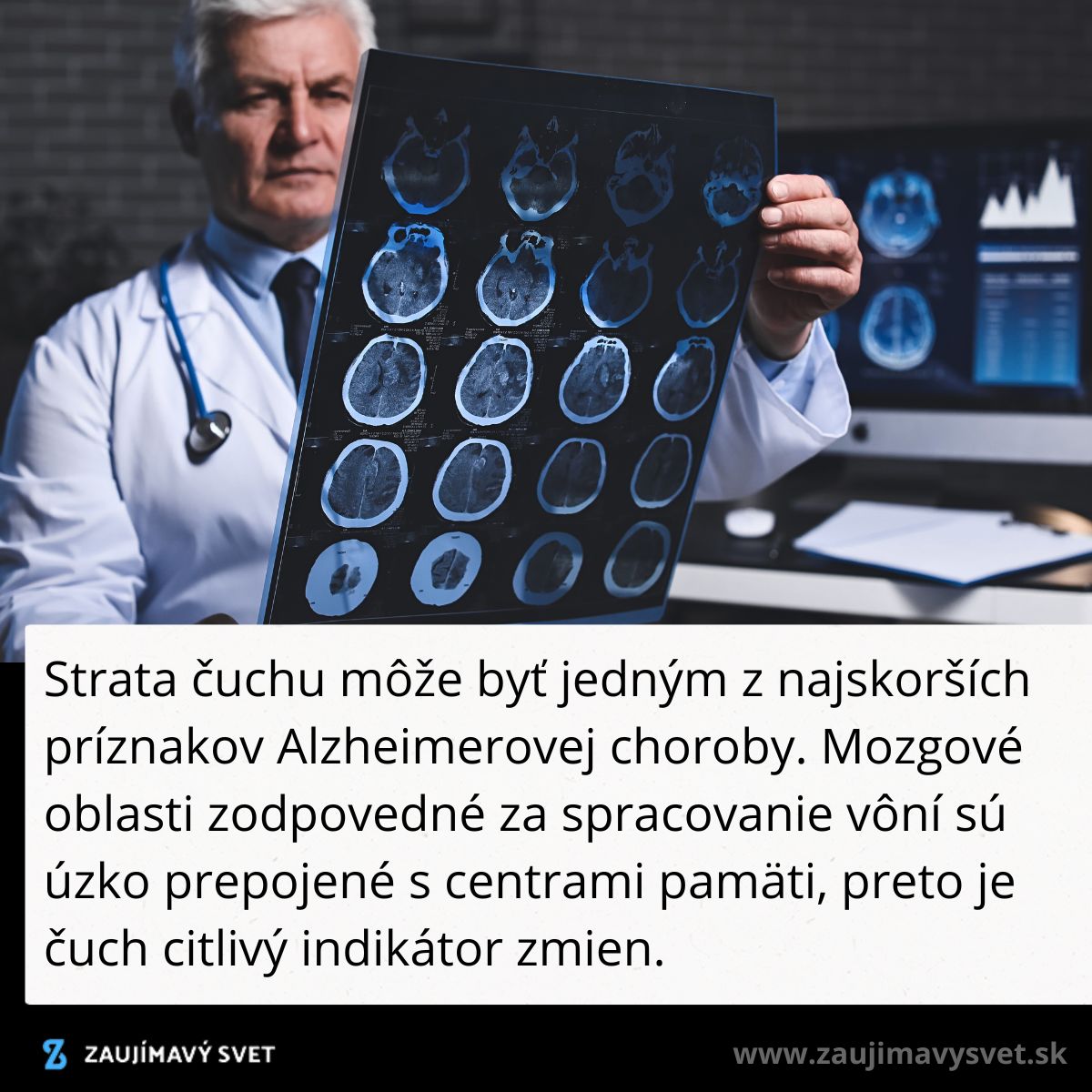 Lekár skúma snímky mozgu na počítači. Strata čuchu môže naznačovať Alzheimerovu chorobu.