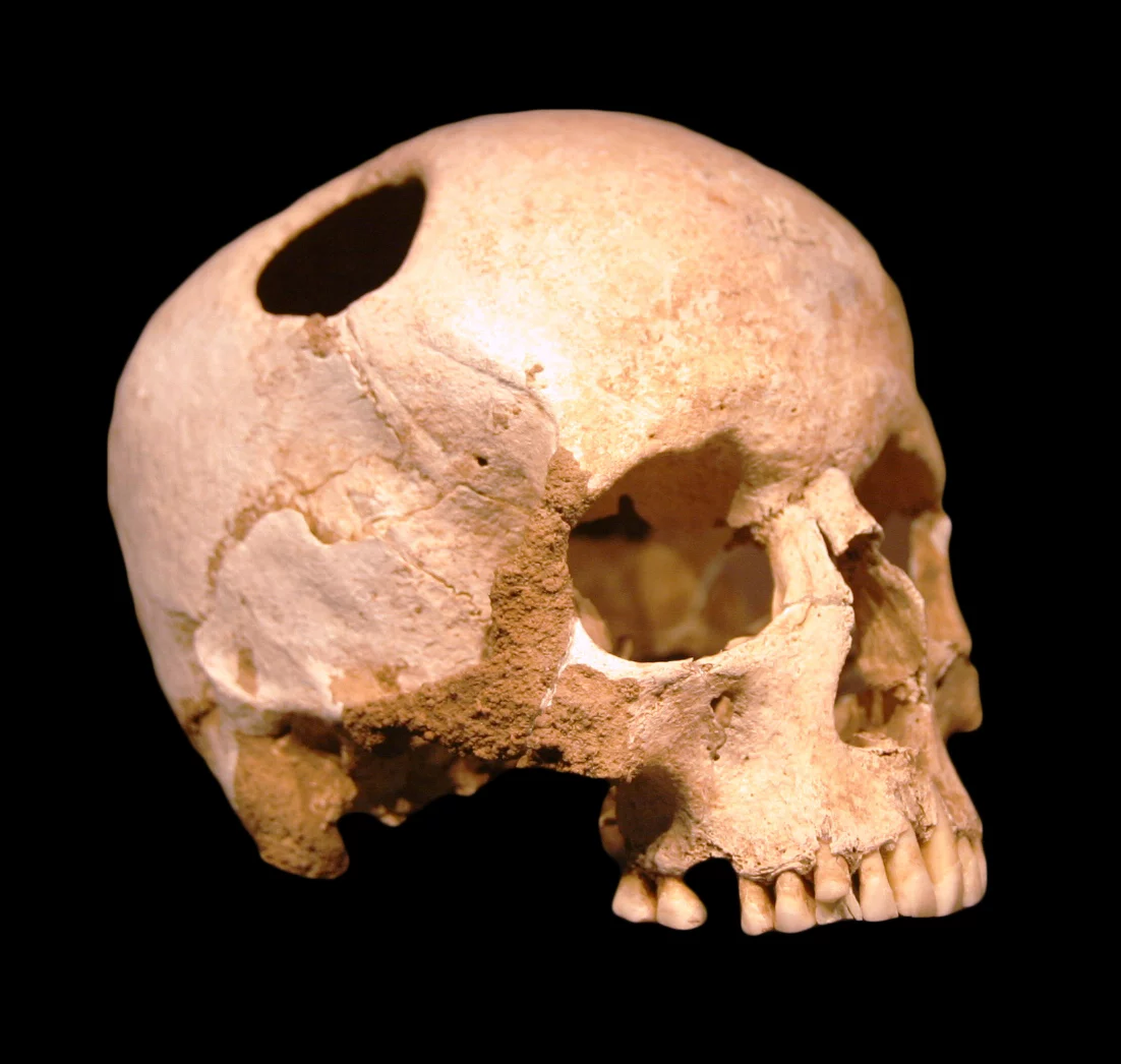 Staroveká lebka s trepanačným otvorom, archeologický nález na čiernom pozadí.