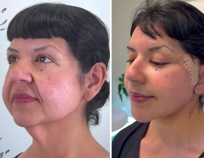 Pred a po faceliftu: Zmena vzhľadu ženy po estetickom chirurgickom zákroku na omladenie tváre.