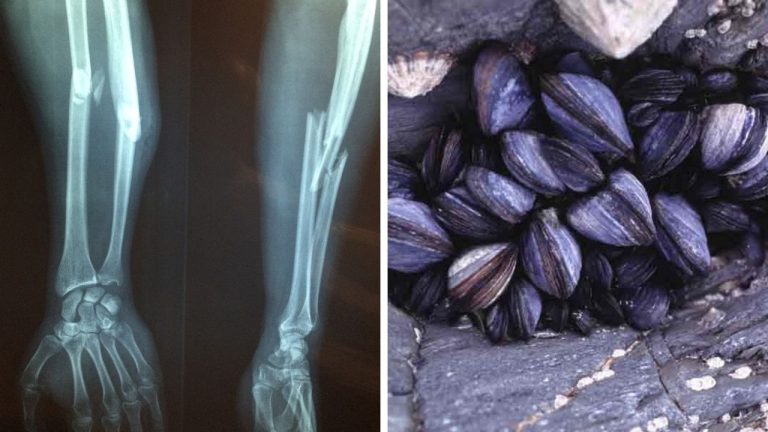 Vedci hľadajú nové riešenie komplikovaných zlomenín. Inšpirovali sa tým, ako sa mušle dokážu prichytávať pod vodou!