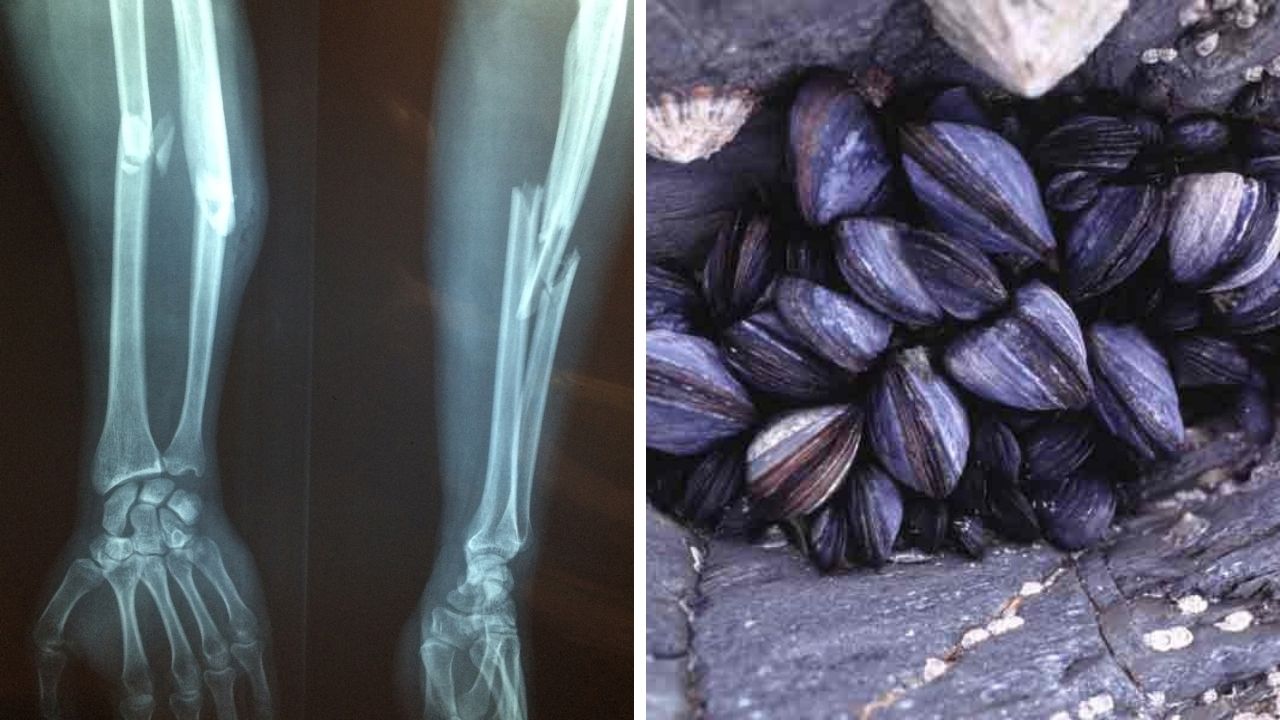 Vedci hľadajú nové riešenie komplikovaných zlomenín. Inšpirovali sa tým, ako sa mušle dokážu prichytávať pod vodou!